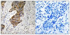 CBR / CBR1 Antibody - Peptide - + Immunohistochemistry analysis of paraffin-embedded human breast carcinoma tissue, using CBR1 antibody.