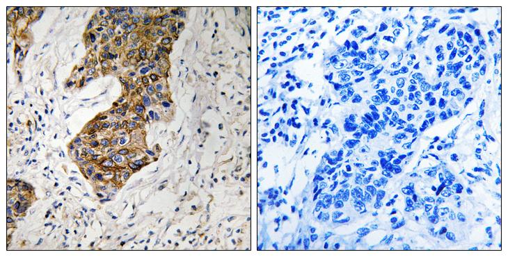 CBR / CBR1 Antibody - Peptide - + Immunohistochemistry analysis of paraffin-embedded human breast carcinoma tissue, using CBR1 antibody.