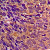 CBR3 Antibody - Immunohistochemical analysis of CBR3 staining in human breast cancer formalin fixed paraffin embedded tissue section. The section was pre-treated using heat mediated antigen retrieval with sodium citrate buffer (pH 6.0). The section was then incubated with the antibody at room temperature and detected with HRP and DAB as chromogen. The section was then counterstained with hematoxylin and mounted with DPX.