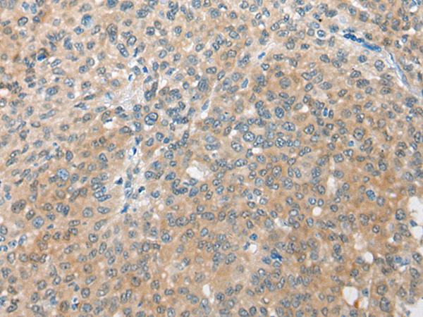 CBR3 Antibody - Immunohistochemistry of paraffin-embedded Human liver cancer tissue  using CBR3 Polyclonal Antibody at dilution of 1:35(×200)