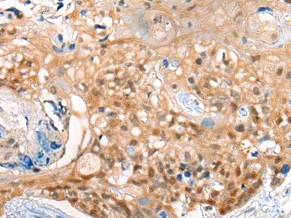 CBR3 Antibody - Immunohistochemistry of paraffin-embedded Human esophagus cancer tissue  using CBR3 Polyclonal Antibody at dilution of 1:35(×200)