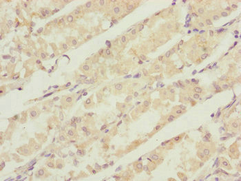 CBR4 Antibody - Immunohistochemistry of paraffin-embedded human gastric cancer at dilution of 1:100