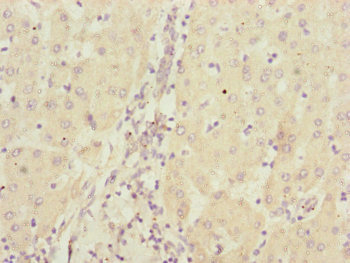 CBR4 Antibody - Immunohistochemistry of paraffin-embedded human liver cancer at dilution of 1:100