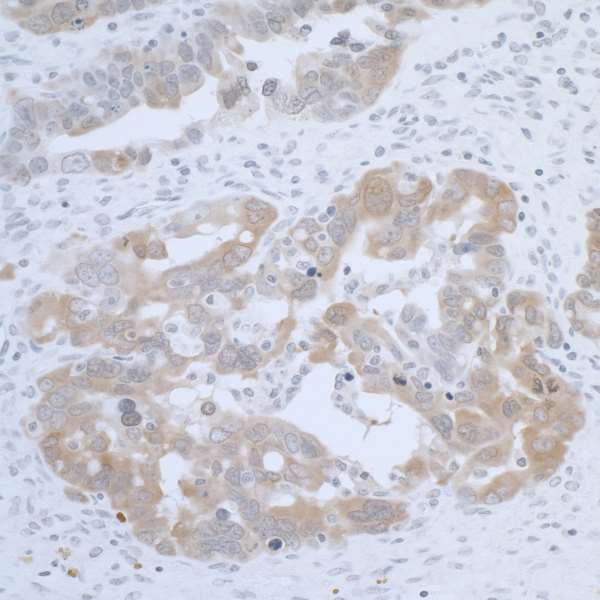 CBS Antibody - Detection of human CBS by immunohistochemistry. Sample: FFPE section of human ovarian carcinoma. Antibody: Affinity purified rabbit anti-CBS used at a dilution of 1:5000 (0.2µg/ml). Detection: DAB
