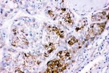 CBS Antibody - CBS antibody IHC-paraffin: Human Liver Cancer Tissue.