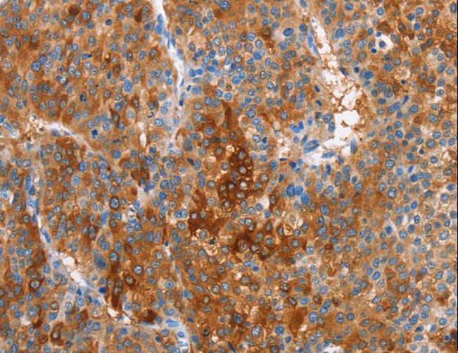 CBS Antibody - Immunohistochemistry of paraffin-embedded Human liver cancer using CBS Polyclonal Antibody at dilution of 1:25.