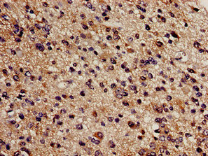CBS Antibody - Immunohistochemistry analysis of human glioma cancer at a dilution of 1:100