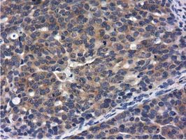 CBWD1 Antibody - IHC of paraffin-embedded Adenocarcinoma of Human ovary tissue using anti-CBWD1 mouse monoclonal antibody.