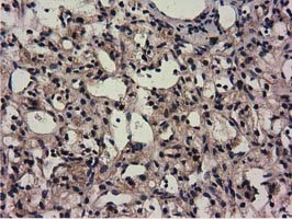 CBWD1 Antibody - IHC of paraffin-embedded Carcinoma of Human kidney tissue using anti-CBWD1 mouse monoclonal antibody.