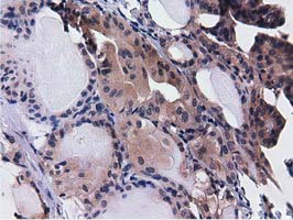 CBWD1 Antibody - IHC of paraffin-embedded Carcinoma of Human thyroid tissue using anti-CBWD1 mouse monoclonal antibody.