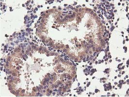CBWD1 Antibody - IHC of paraffin-embedded Carcinoma of Human prostate tissue using anti-CBWD1 mouse monoclonal antibody.