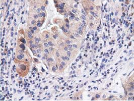 CBWD1 Antibody - IHC of paraffin-embedded Carcinoma of Human bladder tissue using anti-CBWD1 mouse monoclonal antibody.