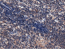 CBWD1 Antibody - Immunohistochemical staining of paraffin-embedded Human lymphoma tissue using anti-CBWD1 mouse monoclonal antibody.