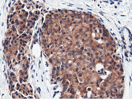 CBWD1 Antibody - Immunohistochemical staining of paraffin-embedded Adenocarcinoma of Human breast tissue using anti-CBWD1 mouse monoclonal antibody.