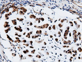 CBWD1 Antibody - Immunohistochemical staining of paraffin-embedded Adenocarcinoma of Human colon tissue using anti-CBWD1 mouse monoclonal antibody.