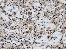 CBWD1 Antibody - Immunohistochemical staining of paraffin-embedded Carcinoma of Human kidney tissue using anti-CBWD1 mouse monoclonal antibody.