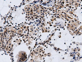 CBWD1 Antibody - Immunohistochemical staining of paraffin-embedded Carcinoma of Human lung tissue using anti-CBWD1 mouse monoclonal antibody.