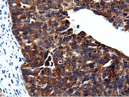 CBWD1 Antibody - Immunohistochemical staining of paraffin-embedded Adenocarcinoma of Human ovary tissue using anti-CBWD1 mouse monoclonal antibody.