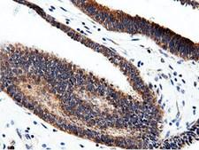 CBWD1 Antibody - Immunohistochemical staining of paraffin-embedded Adenocarcinoma of Human endometrium tissue using anti-CBWD1 mouse monoclonal antibody.