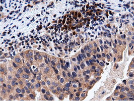 CBWD1 Antibody - Immunohistochemical staining of paraffin-embedded Carcinoma of Human bladder tissue using anti-CBWD1 mouse monoclonal antibody.