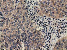 CBWD1 Antibody - Immunohistochemical staining of paraffin-embedded Carcinoma of Human bladder tissue using anti-CBWD1 mouse monoclonal antibody.