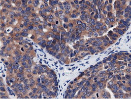 CBWD1 Antibody - Immunohistochemical staining of paraffin-embedded Adenocarcinoma of Human ovary tissue using anti-CBWD1 mouse monoclonal antibody.