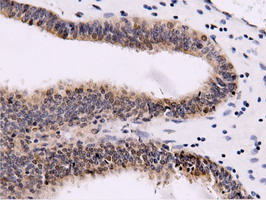 CBWD1 Antibody - Immunohistochemical staining of paraffin-embedded Adenocarcinoma of Human endometrium tissue using anti-CBWD1 mouse monoclonal antibody.