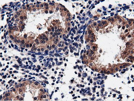 CBWD1 Antibody - Immunohistochemical staining of paraffin-embedded Carcinoma of Human prostate tissue using anti-CBWD1 mouse monoclonal antibody.