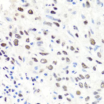CBX1 / HP1 Beta Antibody - Immunohistochemistry of paraffin-embedded Human lung cancer using CBX1 Polyclonal Antibody at dilution of 1:100 (40x lens).