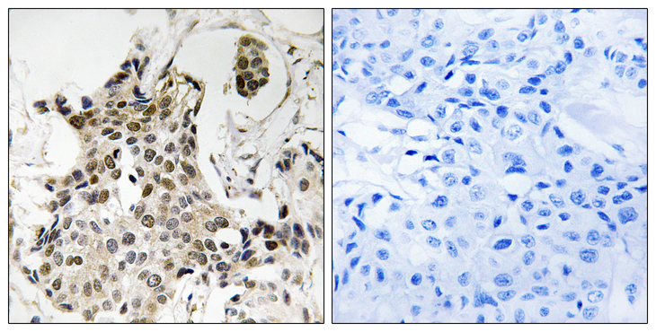 CBX3 / HP1 Gamma Antibody - Immunohistochemistry analysis of paraffin-embedded human breast carcinoma tissue, using HP1 gamma Antibody. The picture on the right is blocked with the synthesized peptide.