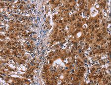 CBX3 / HP1 Gamma Antibody - Immunohistochemistry of paraffin-embedded Human gastric cancer using CBX3 Polyclonal Antibody at dilution of 1:40.