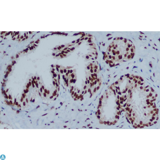 CBX3 / HP1 Gamma Antibody - Immunohistochemical analysis of paraffin-embedded Prostate Cancer using HP1-gamma mouse mAb (1:200 dilution).Antigen retrieval was performed by pressure cooking in citrate buffer (pH 6.0).