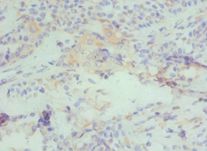 CBX4 Antibody - Immunohistochemistry of paraffin-embedded human breast cancer using antibody at 1:100 dilution.
