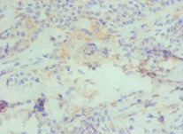 CBX4 Antibody - Immunohistochemistry of paraffin-embedded human breast cancer using CBX4 Antibody at dilution of 1:100