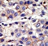 CBX4 Antibody - Formalin-fixed and paraffin-embedded human cancer tissue reacted with the primary antibody, which was peroxidase-conjugated to the secondary antibody, followed by AEC staining. This data demonstrates the use of this antibody for immunohistochemistry; clinical relevance has not been evaluated. BC = breast carcinoma; HC = hepatocarcinoma.