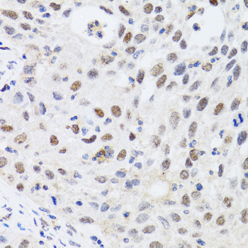 CBX4 Antibody - Immunohistochemistry of paraffin-embedded human lung cancer tissue.
