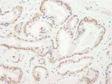 CBX5 / HP1 Alpha Antibody - Detection of Human CBX5 by Immunohistochemistry. Sample: FFPE section of human prostate carcinoma. Antibody: Affinity purified rabbit anti-CBX5 used at a dilution of 1:5000 (0.2 ug/ml).