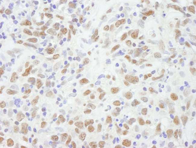 CBX5 / HP1 Alpha Antibody - Detection of Human CBX5 by Immunohistochemistry. Sample: FFPE section of human metastatic lymph node. Antibody: Affinity purified rabbit anti-CBX5 used at a dilution of 1:250.