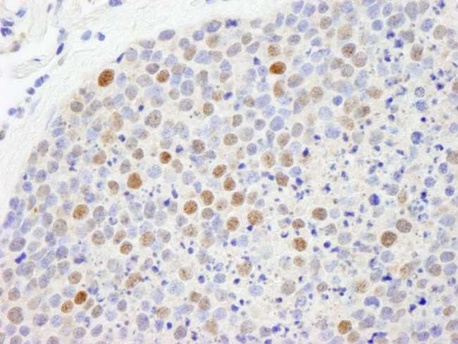 CBX5 / HP1 Alpha Antibody - Detection of Human CBX5 by Immunohistochemistry. Sample: FFPE section of human small cell lung cancer. Antibody: Affinity purified rabbit anti-CBX5 used at a dilution of 1:250.