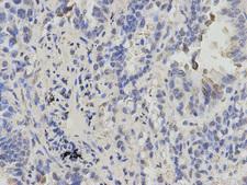 CBX5 / HP1 Alpha Antibody - Immunohistochemistry of paraffin-embedded human lung cancer using CBX5 antibody at dilution of 1:200 (400x lens).