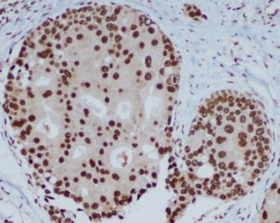 CBX5 / HP1 Alpha Antibody - Immunohistochemical analysis of paraffin-embedded human breast carcinoma with HP1 alpha mouse monoclonal antibody (3G2-H10-A6, 1:400 diluted ), showing nuclear localization.A high pressure mediated antigen retrieval step was performed in citrate buffer(pH 6.0).