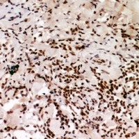CBX5 / HP1 Alpha Antibody - Immunohistochemical analysis of HP1 alpha (pS92) staining in human breast cancer formalin fixed paraffin embedded tissue section. The section was pre-treated using heat mediated antigen retrieval with sodium citrate buffer (pH 6.0). The section was then incubated with the antibody at room temperature and detected using an HRP conjugated compact polymer system. DAB was used as the chromogen. The section was then counterstained with haematoxylin and mounted with DPX.