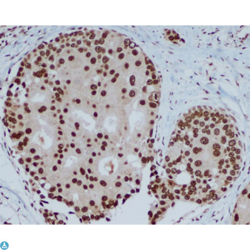 CBX5 / HP1 Alpha Antibody - Immunohistochemical analysis of paraffin-embedded human breast carcinoma with HP1 alpha mouse mAb (3G2-H10-A6, 1:400 diluted ),showing nuclear localization.A high pressure mediated antigen retrieval step was performed in citrat buffer (pH6.0).
