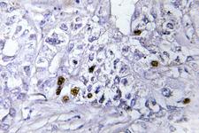 CBX5 / HP1 Alpha Antibody - IHC of HP1 (K69)pAb in paraffin-embedded human liver carcinoma tissue.