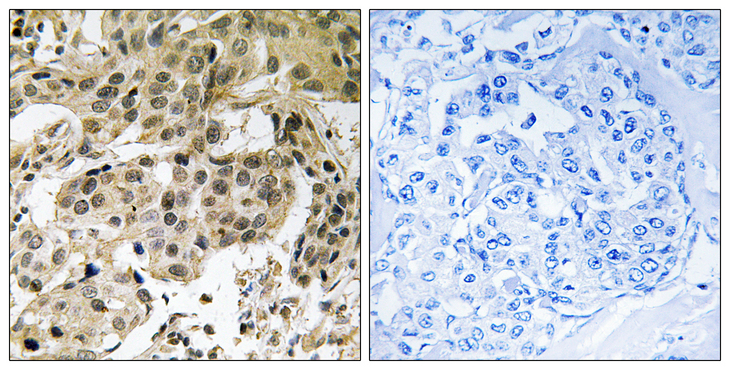 CBX5 / HP1 Alpha Antibody - Immunohistochemistry analysis of paraffin-embedded human breast carcinoma, using HP1 alpha (Phospho-Ser92) Antibody. The picture on the right is blocked with the phospho peptide.