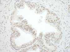CBX7 Antibody - Detection of Human CBX7 by Immunohistochemistry. Sample: FFPE section of human prostate carcinoma. Antibody: Affinity purified rabbit anti-CBX7 used at a dilution of 1:250.