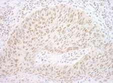 CBX7 Antibody - Detection of Human CBX7 by Immunohistochemistry. Sample: FFPE section of human lung carcinoma. Antibody: Affinity purified rabbit anti-CBX7 used at a dilution of 1:200 (1 ug/ml).
