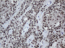 CBX8 Antibody - IHC of paraffin-embedded Carcinoma of Human pancreas tissue using anti-CBX8 mouse monoclonal antibody.