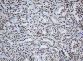 CBX8 Antibody - IHC of paraffin-embedded Carcinoma of Human thyroid tissue using anti-CBX8 mouse monoclonal antibody.