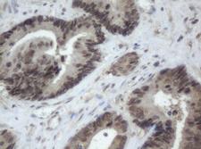 CBX8 Antibody - IHC of paraffin-embedded Adenocarcinoma of Human colon tissue using anti-CBX8 mouse monoclonal antibody. (Heat-induced epitope retrieval by 10mM citric buffer, pH6.0, 120°C for 3min).